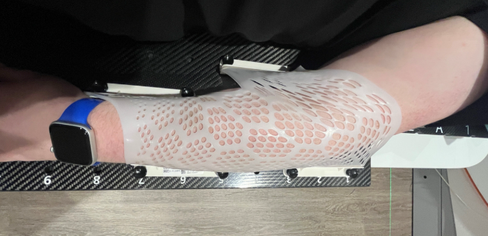Extremity Immobilization for Low Dose Radiation Therapy - elbow