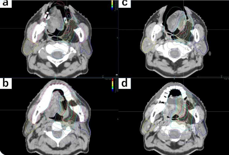 Planning comparison: tongue displacement and dose
