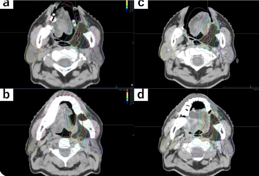 Planning comparison: tongue displacement and dose